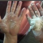 Polyurethane foam on hands
